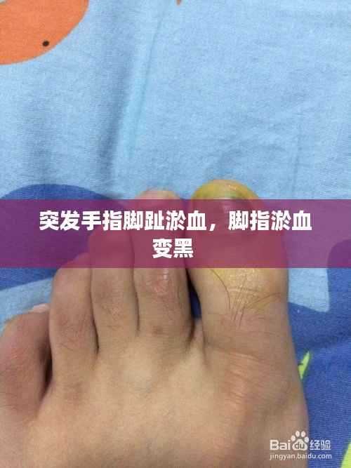突发手指脚趾淤血，脚指淤血变黑 